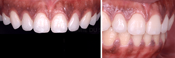 Gingivoplastie