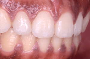 Gingivoplastie