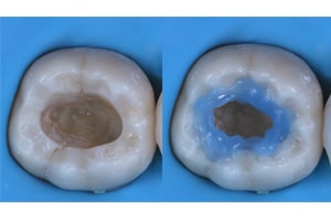 Replica Posterior composite