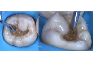 Replica Posterior composite