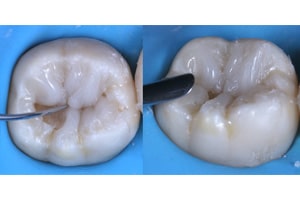 Replica Posterior composite
