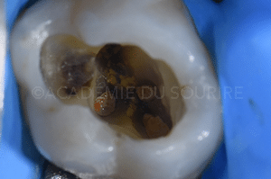 Composites fibrés dentaire