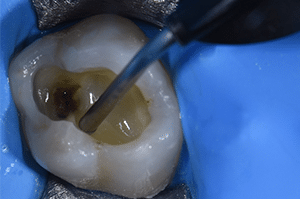 Composites fibrés dentaire