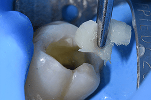 Composites fibrés dentaire