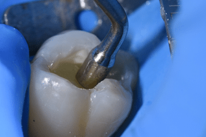 Composites fibrés dentaire