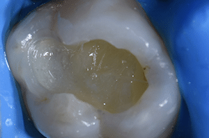 Composites fibrés dentaire