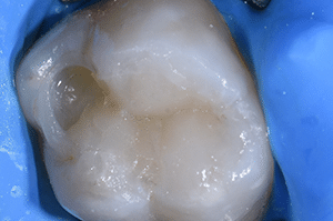 Composites fibrés dentaire