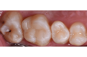 Composites fibrés dentaire