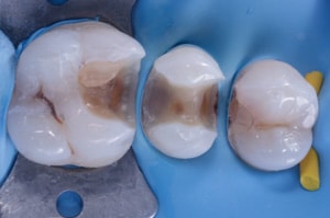 Empreinte optique bords d'inlays