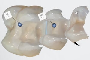 Empreinte optique bords d'inlays