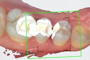 Empreinte optique bords d'inlays