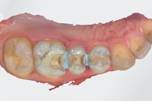 Empreinte optique bords d'inlays