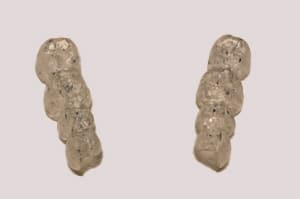 Rebasage orthèses dentaire occlusion
