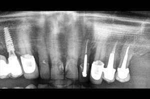 Prise en charge caries profondes