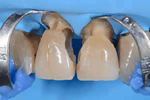 Prise en charge caries profondes