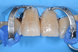 Prise en charge caries profondes