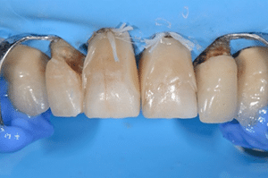 Prise en charge caries profondes