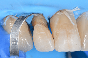 Prise en charge caries profondes