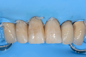 Prise en charge caries profondes