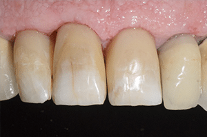 Prise en charge caries profondes