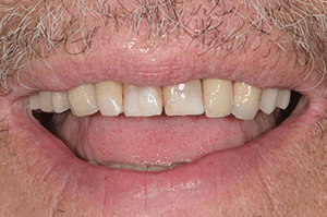 Prise en charge caries profondes