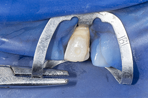 Stabilisation crampon facettes