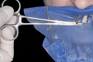 Stabilisation crampon facettes