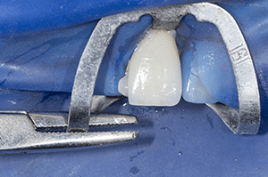 Stabilisation crampon facettes