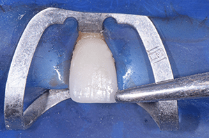 Stabilisation crampon facettes