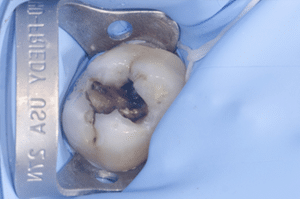 Collage biodentine