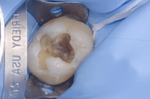 Collage biodentine