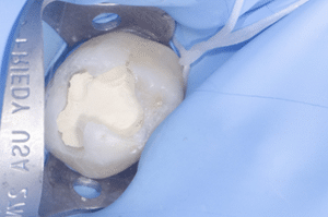 Collage biodentine