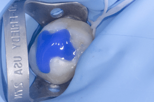 Collage biodentine