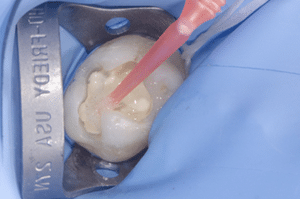 Collage biodentine