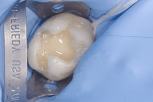 Collage biodentine