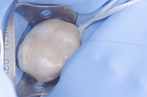 Collage biodentine