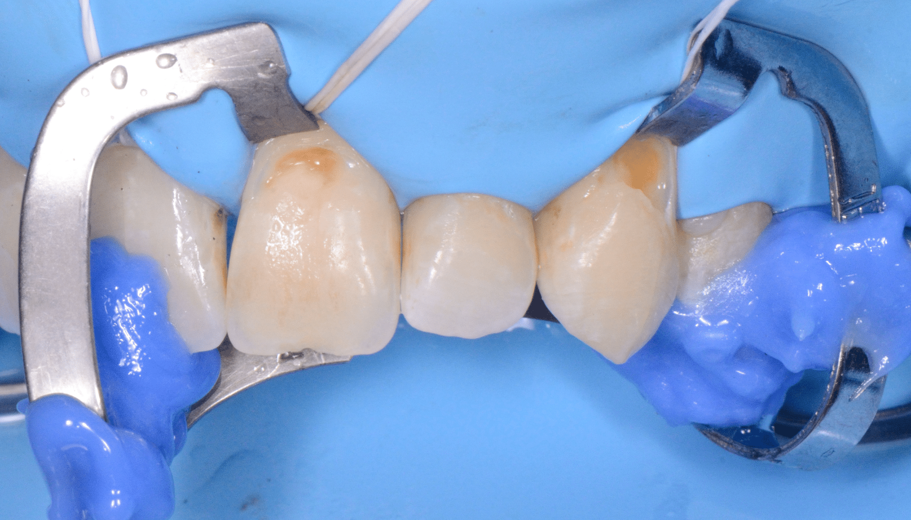 Acces soins sous gingivaux demi clamp