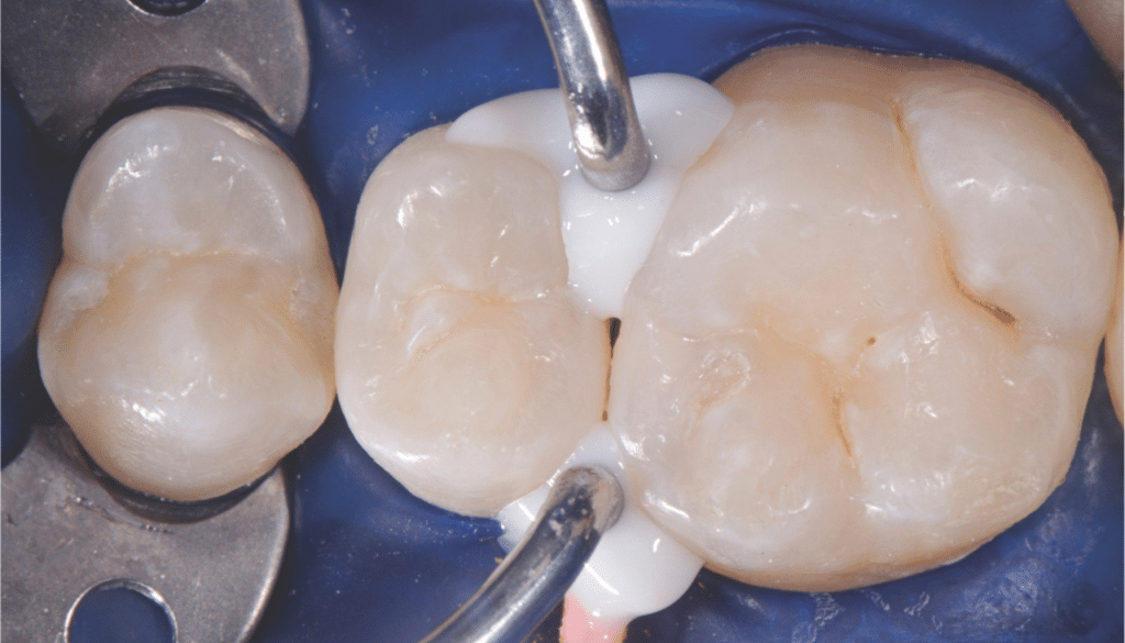 Anneau pour modifier point de contact dentaire