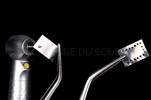 Empreinte facettes dentaire