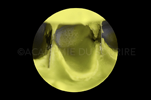 Empreinte facettes dentaire