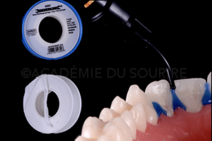 Empreinte facettes dentaire