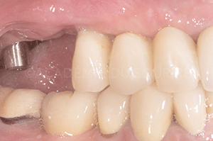 Enregistrement occlusal