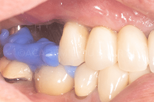 Enregistrement occlusal