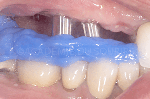 Enregistrement occlusal