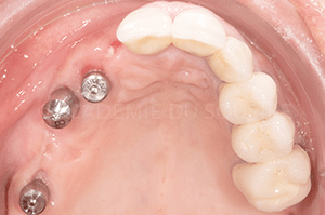 Enregistrement occlusal