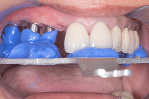 Enregistrement occlusal