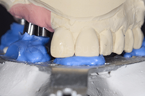 Enregistrement occlusal