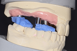 Enregistrement occlusal