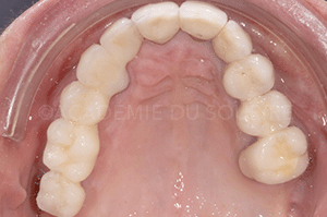 Enregistrement occlusal