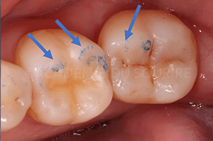 Marquage occlusion dentaire